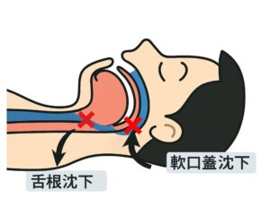 睡眠時無呼吸症候群の原因，いびきの原因，舌根沈下，軟口蓋沈下