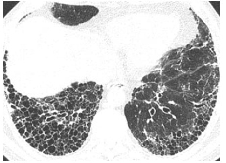 間質性肺炎の蜂巣肺